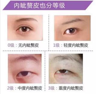 內眥贅皮