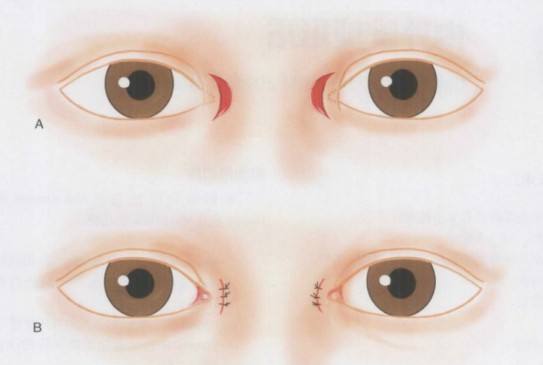 開眼角術前.jpg