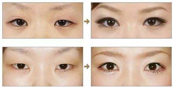 內眥贅皮手術.jpg