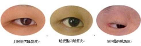 內眥贅皮.jpg