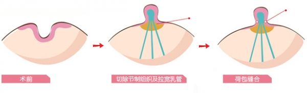 乳頭內陷手術.jpg