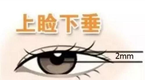 上瞼下垂手術.jpg
