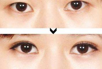 雙眼皮手術