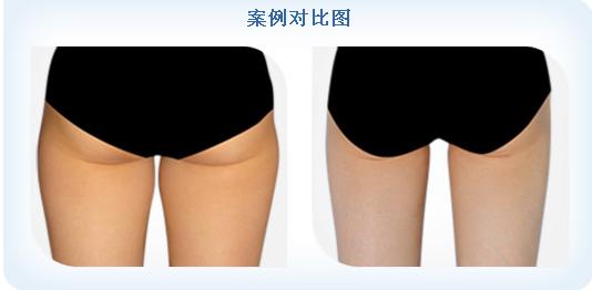 臀部吸脂手術.jpg