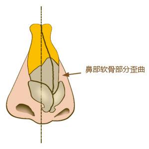 歪鼻矯正術.jpg