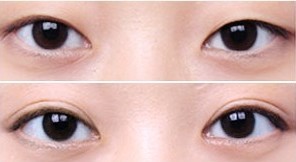 眼部整形手術案例——吳女士